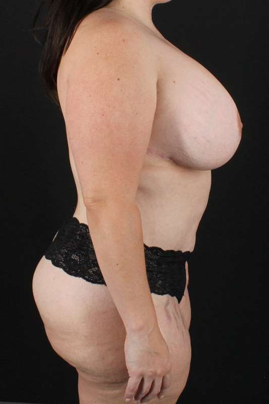 All Me Augmentation Before & After Patient #9681