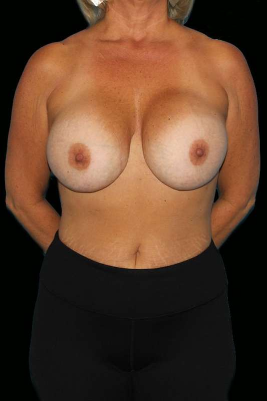 All Me Augmentation Before & After Patient #9632