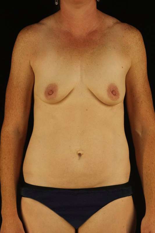 All Me Augmentation Before & After Patient #9639