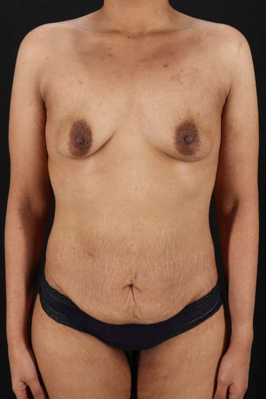All Me Augmentation Before & After Patient #9646