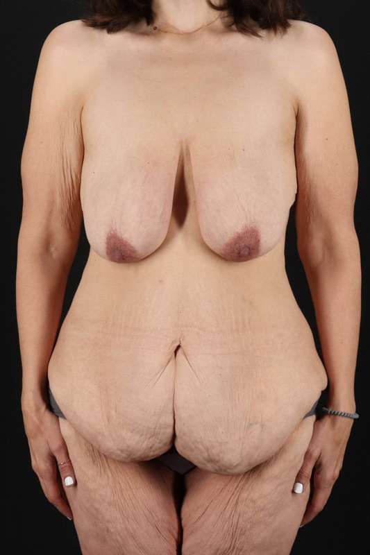 All Me Augmentation Before & After Patient #9667