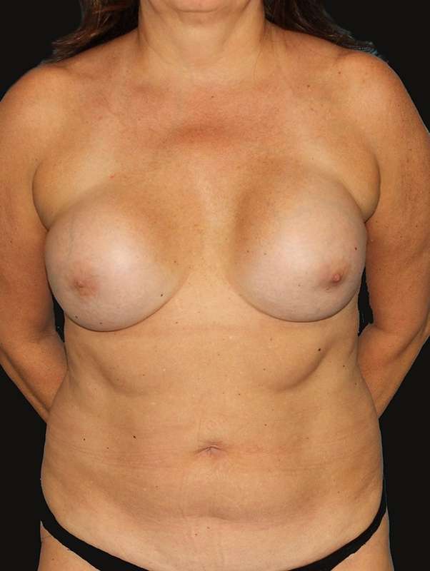 All Me Augmentation Before & After Patient #9618