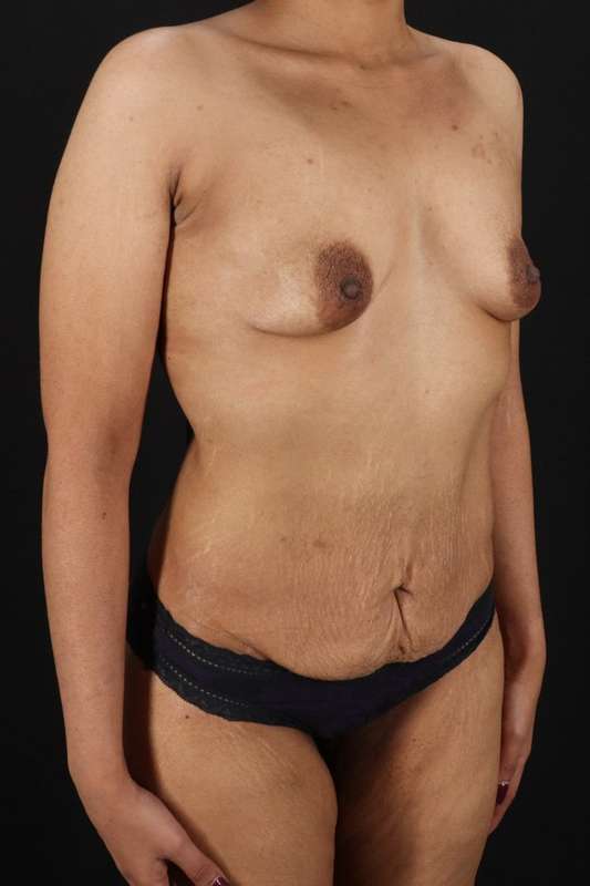 All Me Augmentation Before & After Patient #9646