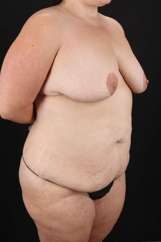 All Me Augmentation Before & After Patient #9681
