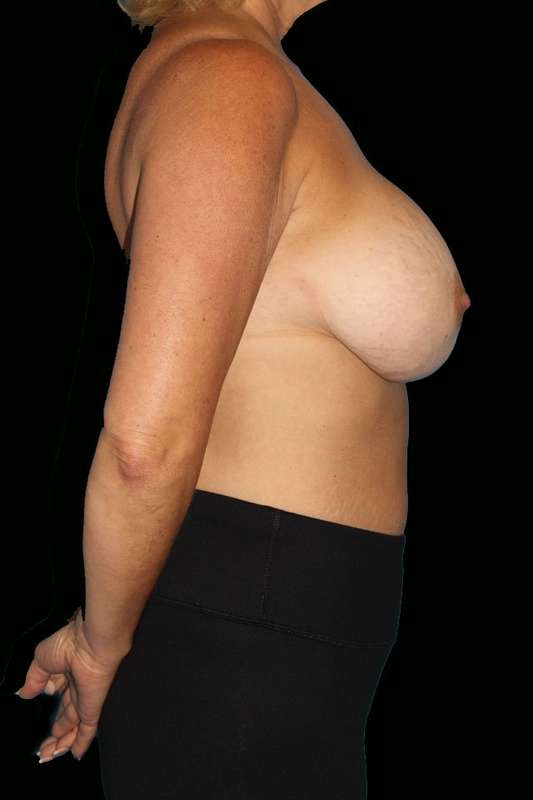 All Me Augmentation Before & After Patient #9632