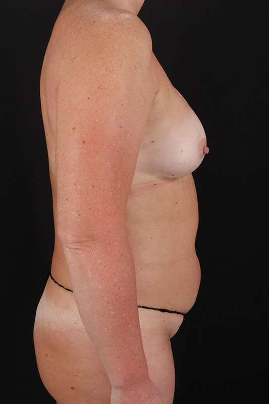 All Me Augmentation Before & After Patient #9695