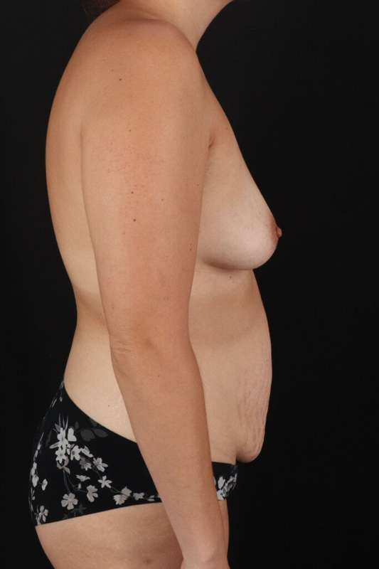 All Me Augmentation Before & After Patient #9702