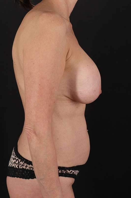 All Me Augmentation Before & After Patient #9709
