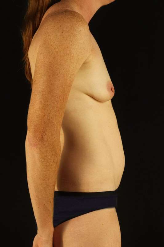 All Me Augmentation Before & After Patient #9639