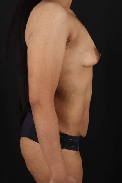 All Me Augmentation Before & After Patient #9646