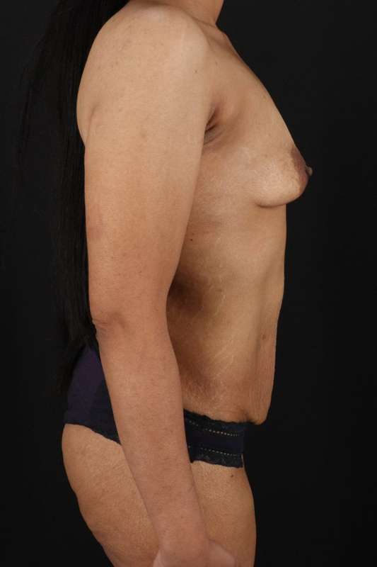 All Me Augmentation Before & After Patient #9646