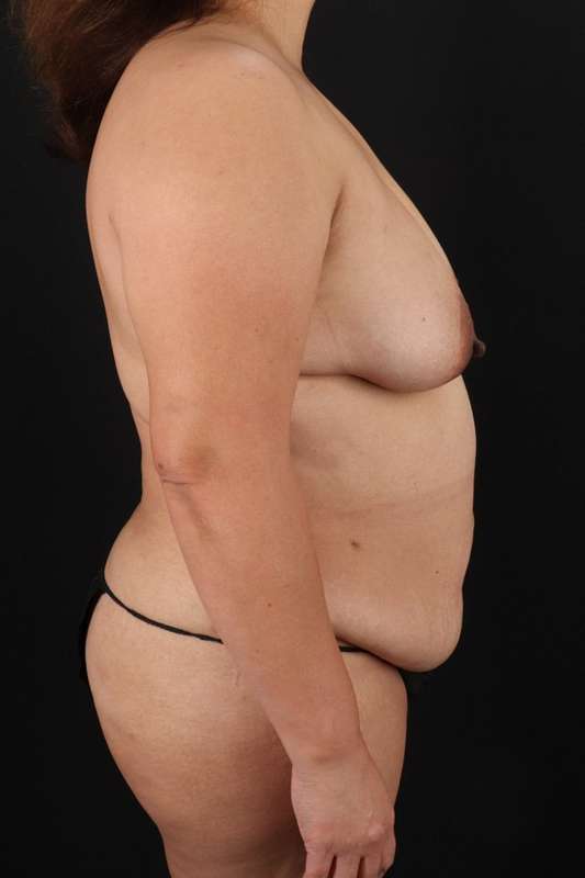 All Me Augmentation Before & After Patient #9653