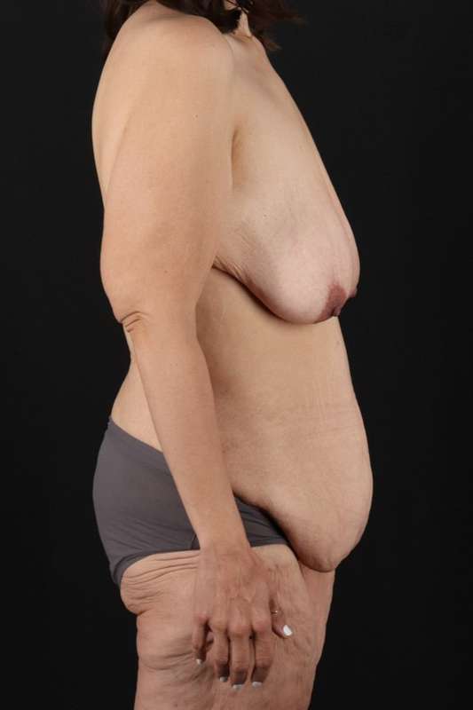All Me Augmentation Before & After Patient #9667