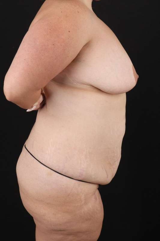 All Me Augmentation Before & After Patient #9681