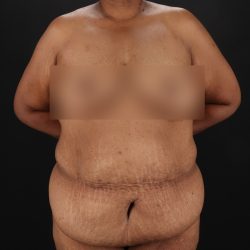 Cosmetic Body Lift Before & After Patient #9761