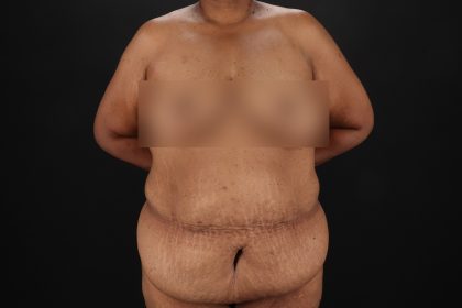 Cosmetic Body Lift Before & After Patient #9761