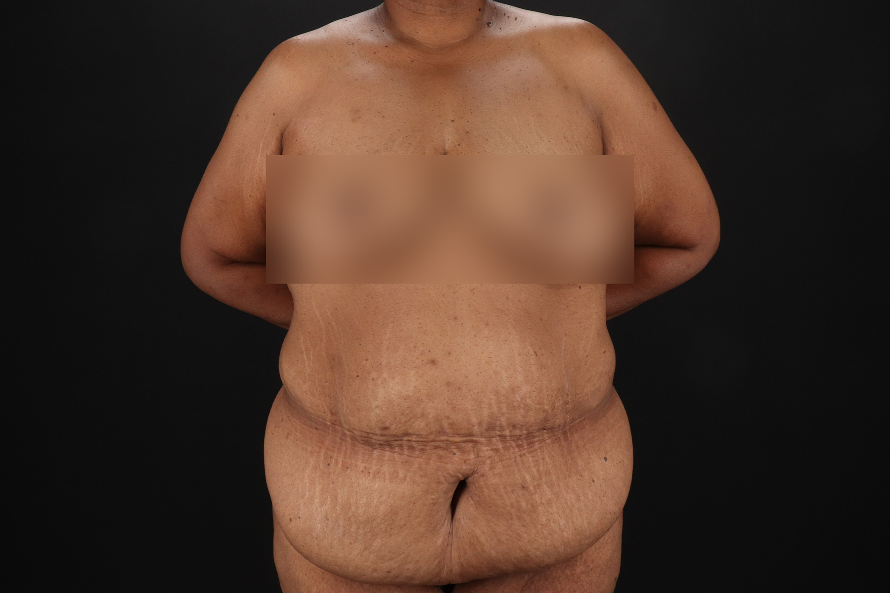 Cosmetic Body Lift Before & After Patient #9761