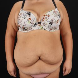 Cosmetic Body Lift Before & After Patient #9766