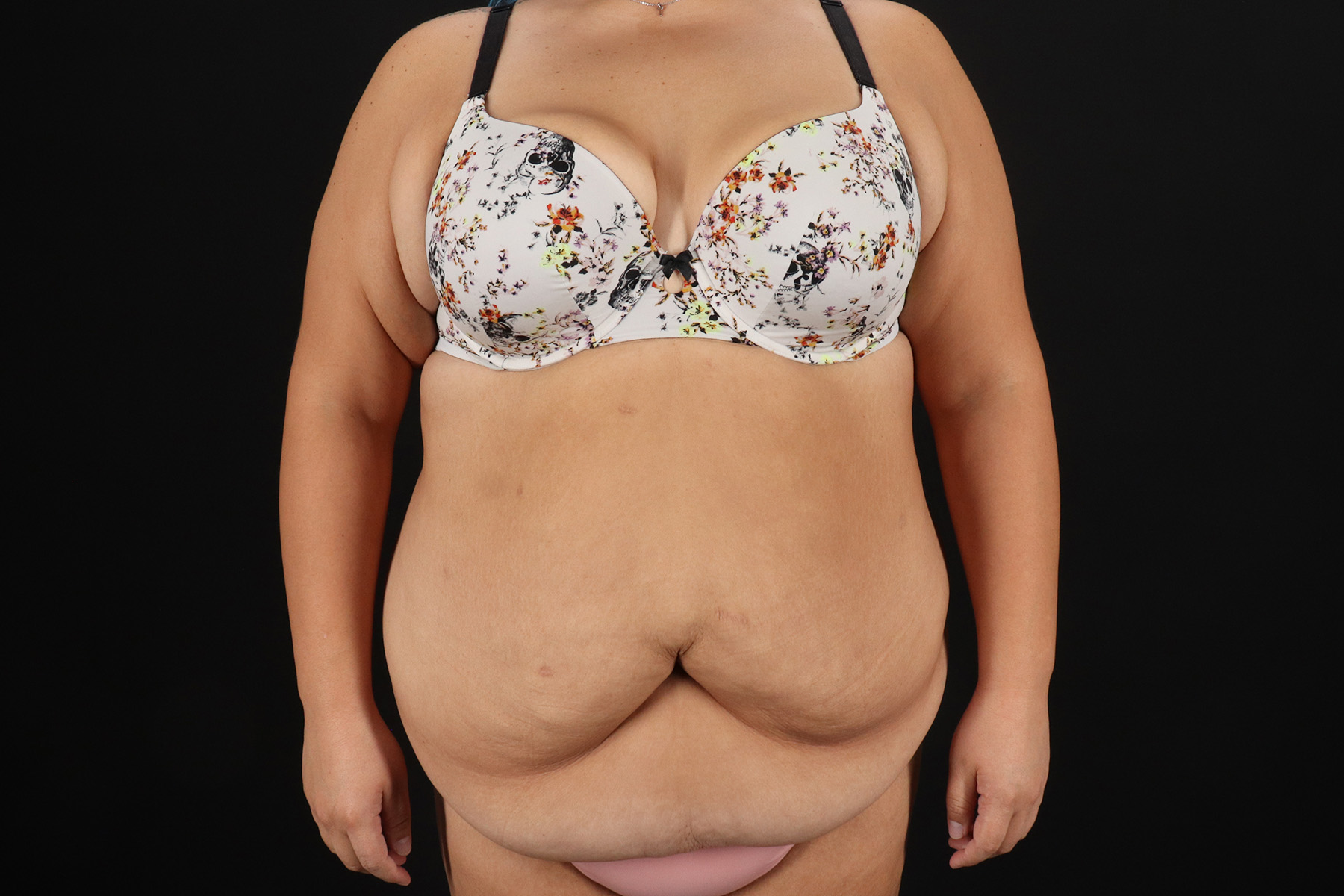 Cosmetic Body Lift Before & After Patient #9766