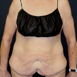 Cosmetic Body Lift Before & After Patient #9762