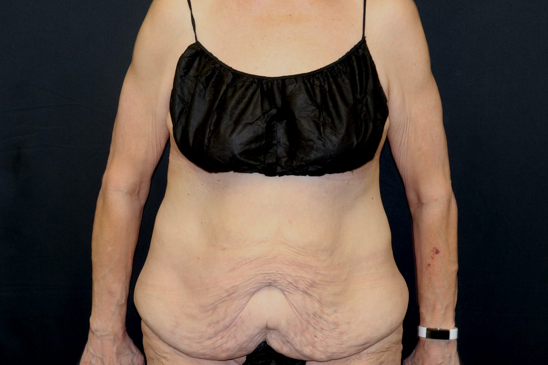 Cosmetic Body Lift Before & After Patient #9762