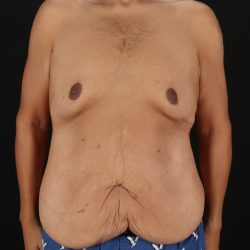 Cosmetic Body Lift Before & After Patient #9764