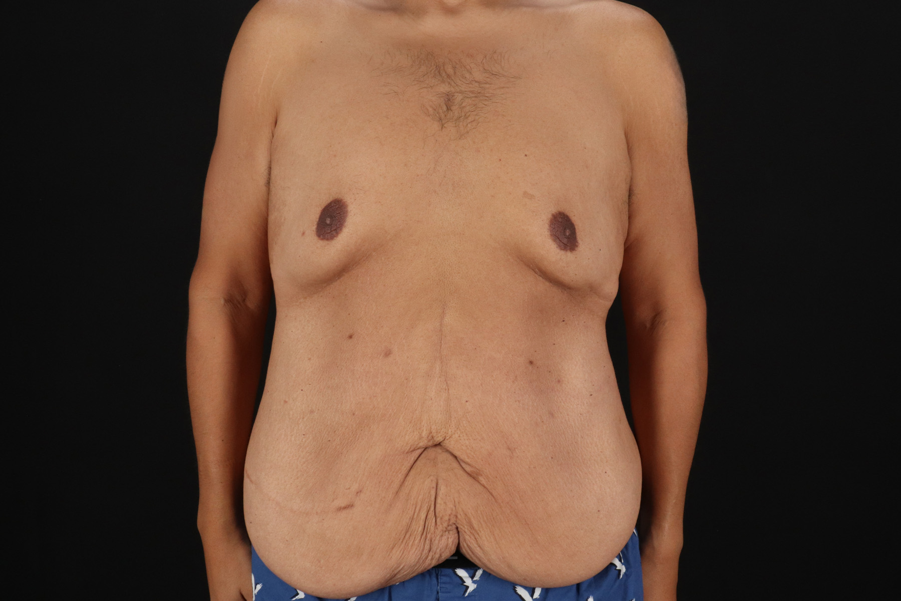 Cosmetic Body Lift Before & After Patient #9764