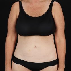 Cosmetic Body Lift Before & After Patient #9767