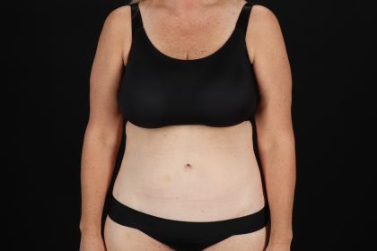 Cosmetic Body Lift Before & After Patient #9767