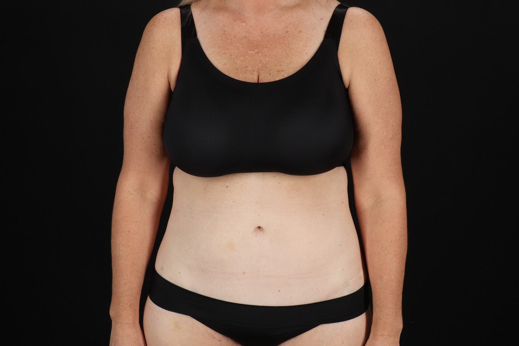 Cosmetic Body Lift Before & After Patient #9767