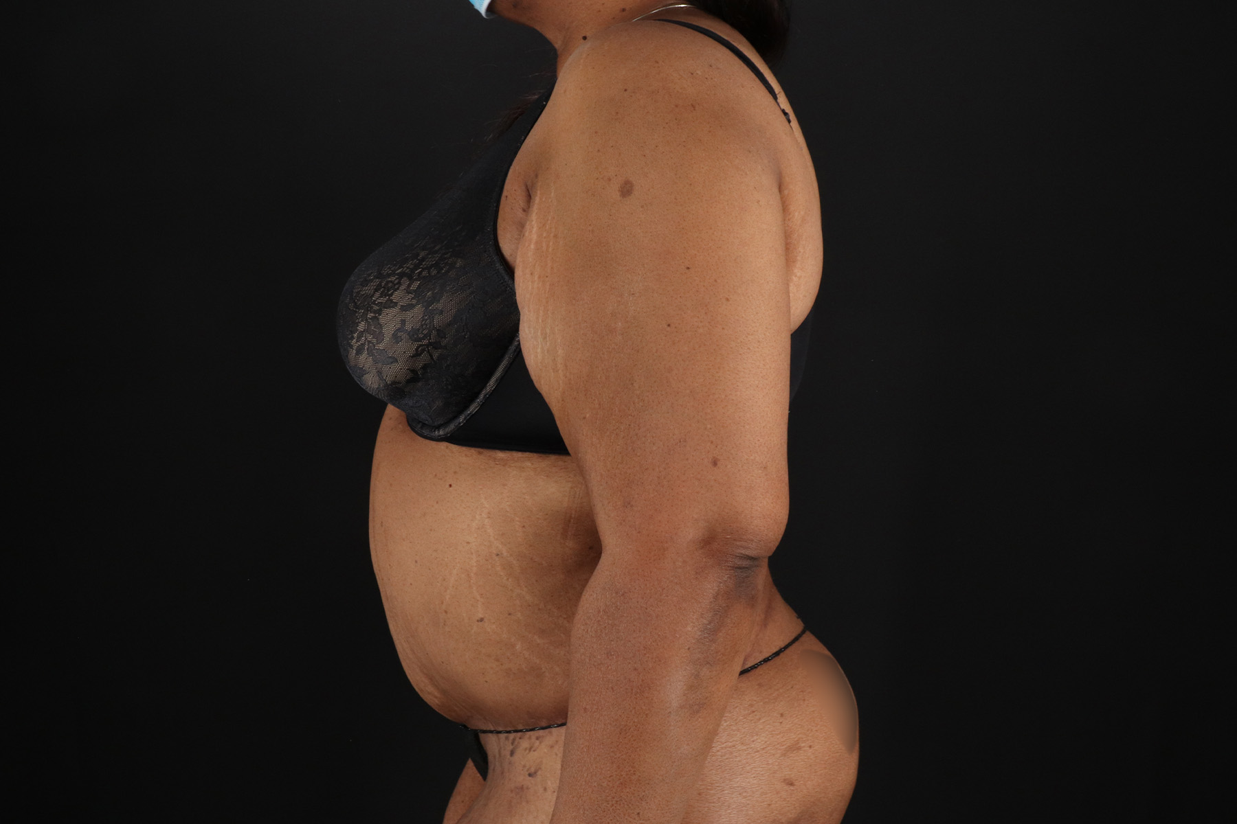 Cosmetic Body Lift Before & After Patient #9761
