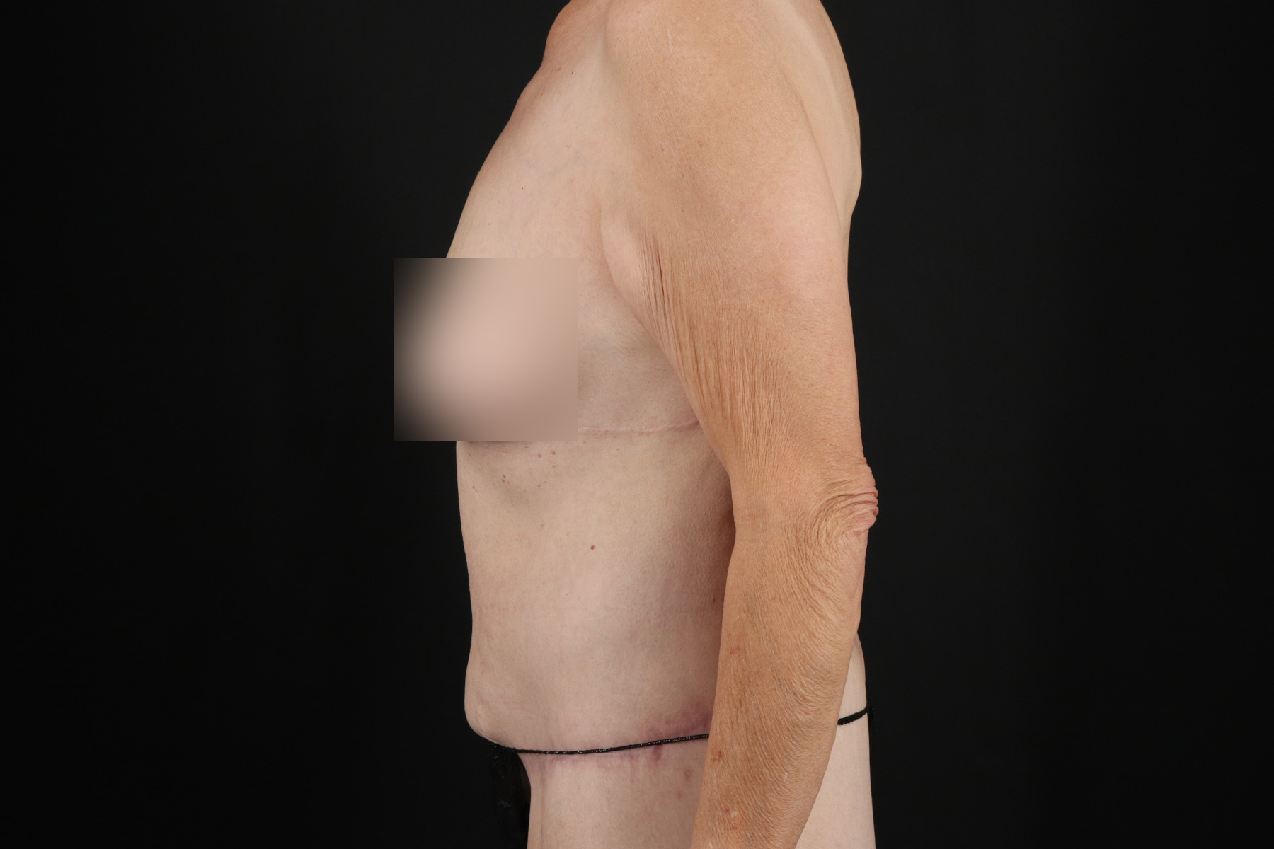 Cosmetic Body Lift Before & After Patient #9762