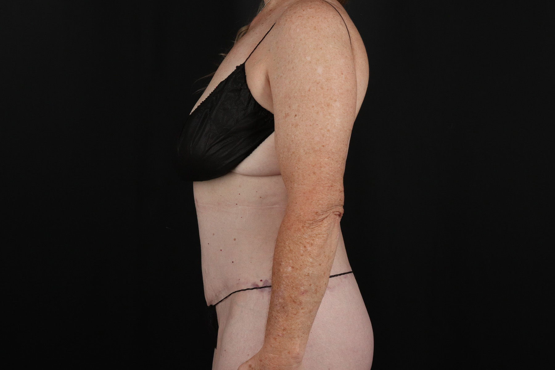 Cosmetic Body Lift Before & After Patient #9757