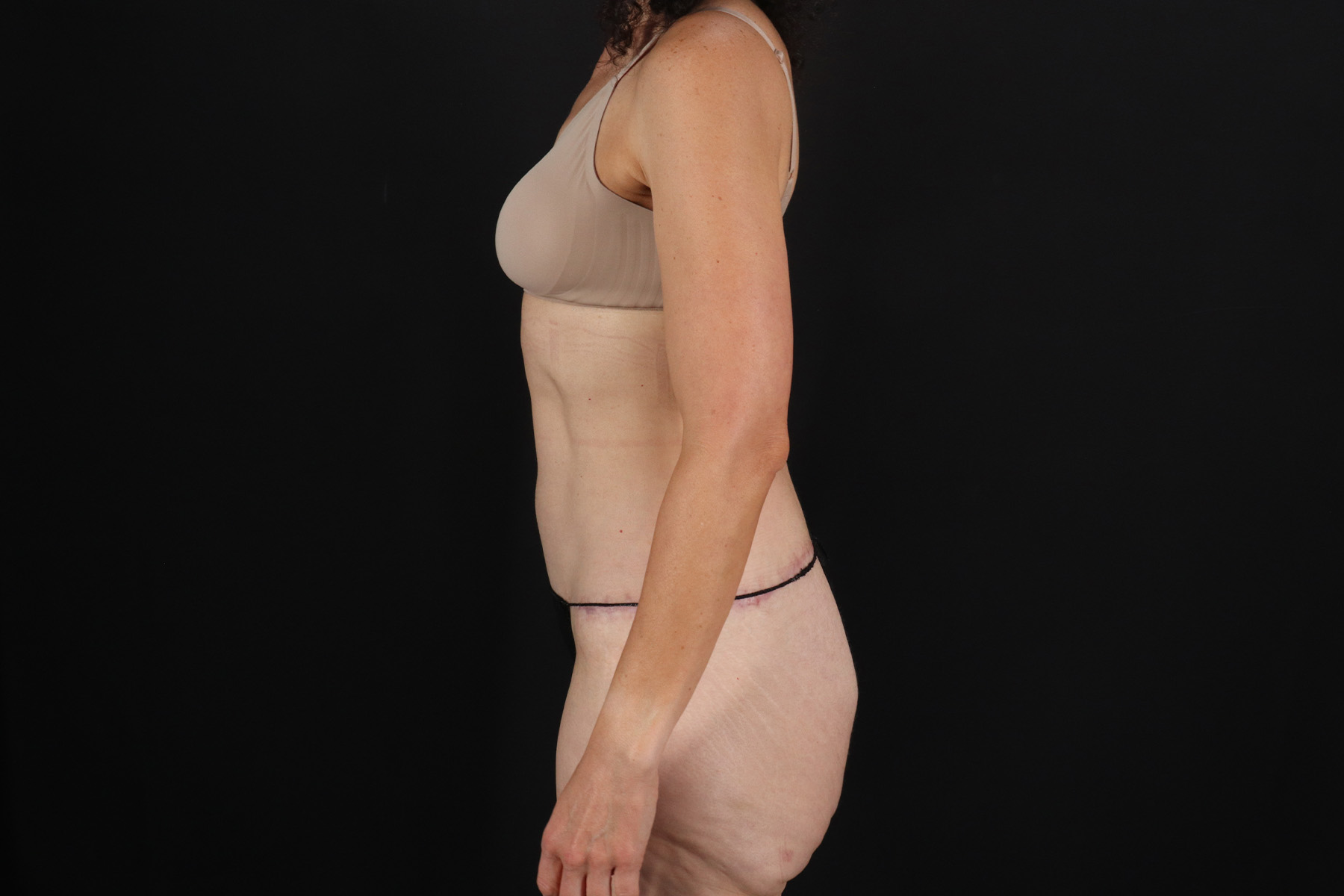 Cosmetic Body Lift Before & After Patient #9760
