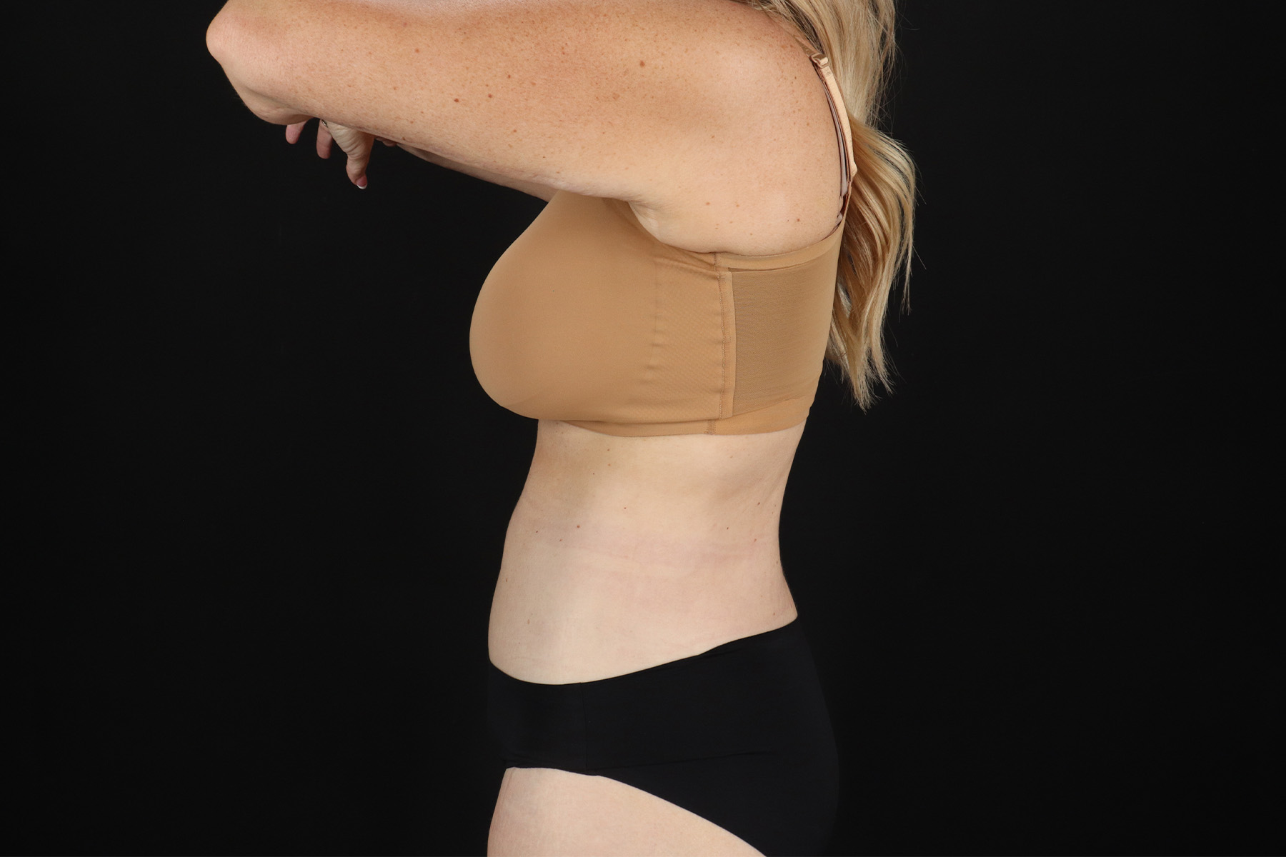 Cosmetic Body Lift Before & After Patient #9767