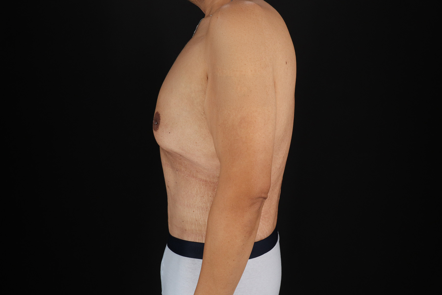 Cosmetic Body Lift Before & After Patient #9764