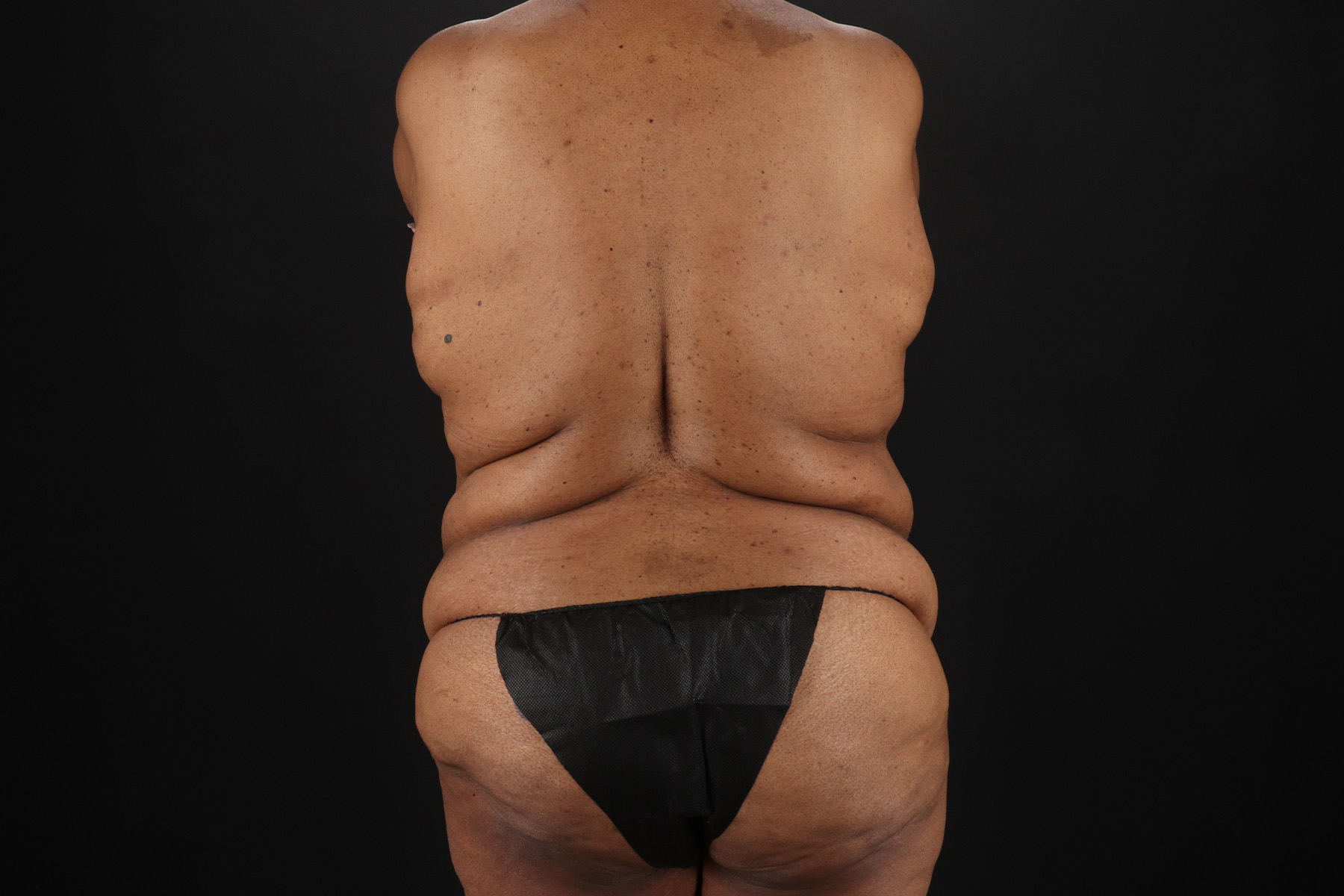 Cosmetic Body Lift Before & After Patient #9761