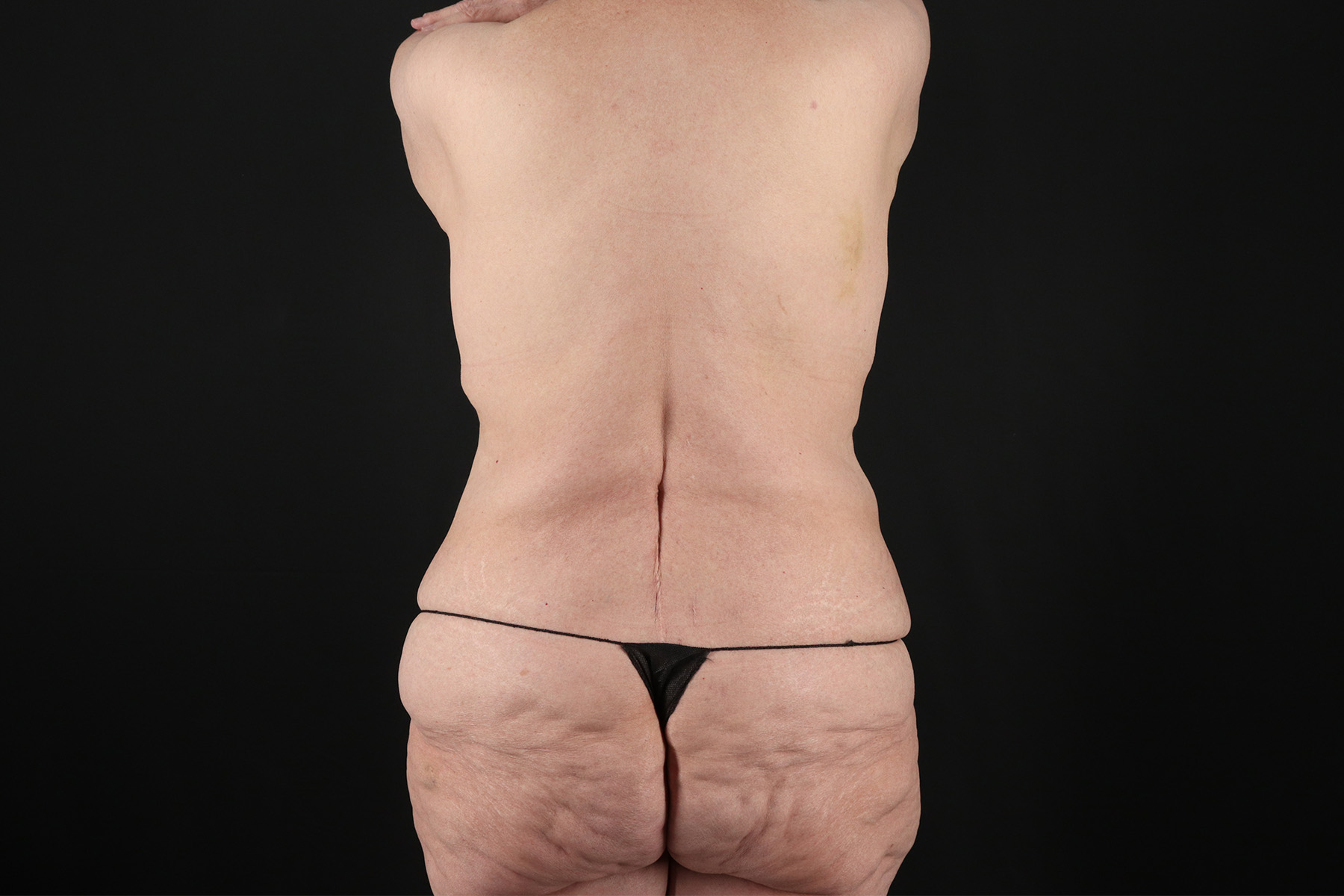 Cosmetic Body Lift Before & After Patient #9771