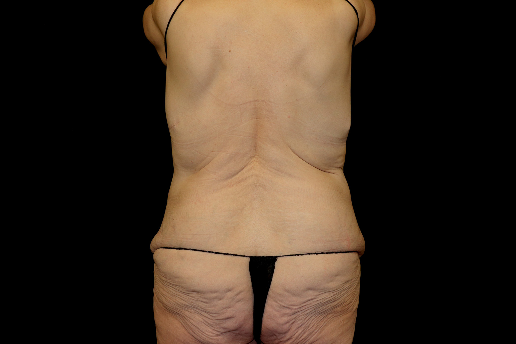 Cosmetic Body Lift Before & After Patient #9762