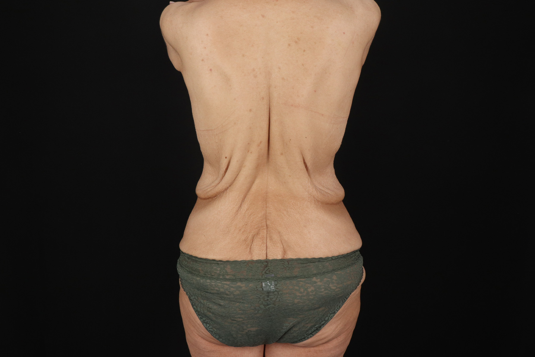 Cosmetic Body Lift Before & After Patient #9756
