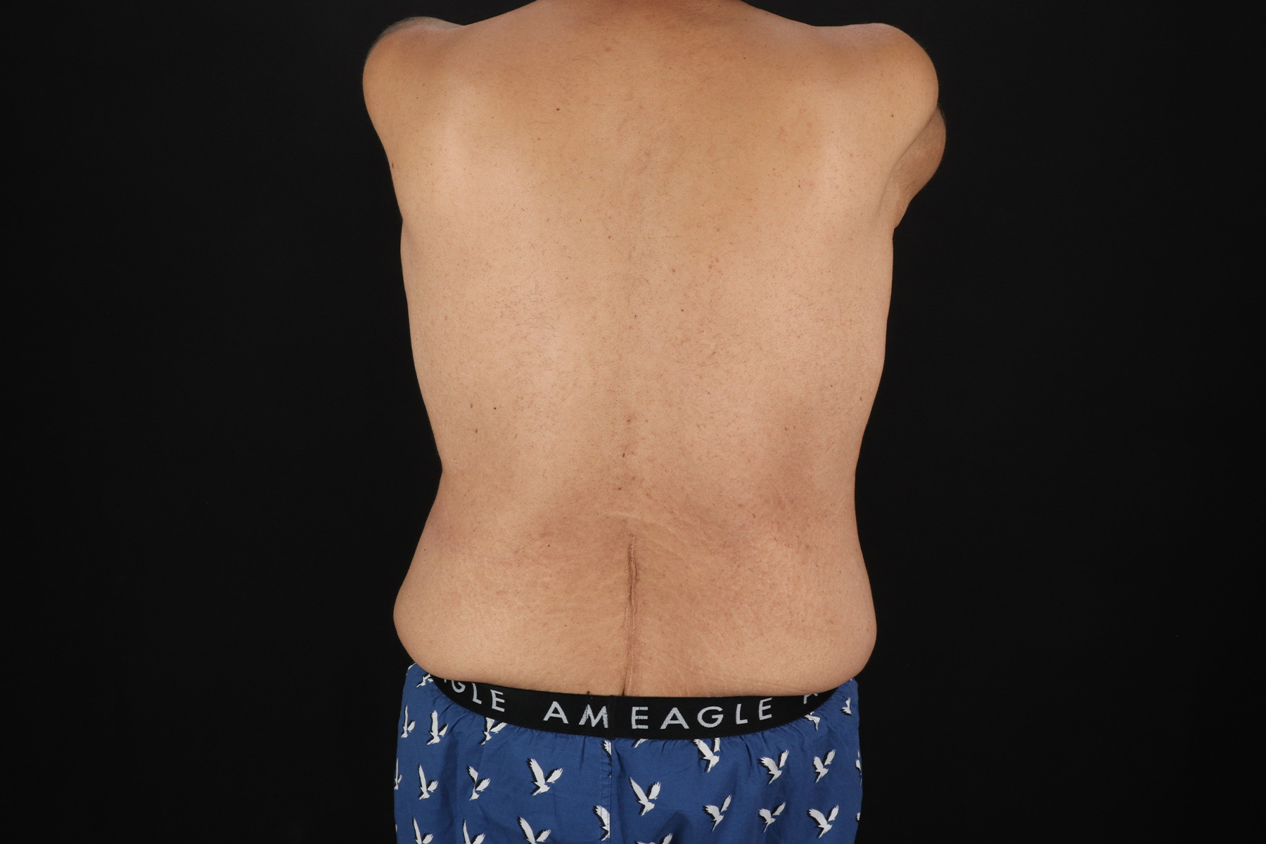 Cosmetic Body Lift Before & After Patient #9764