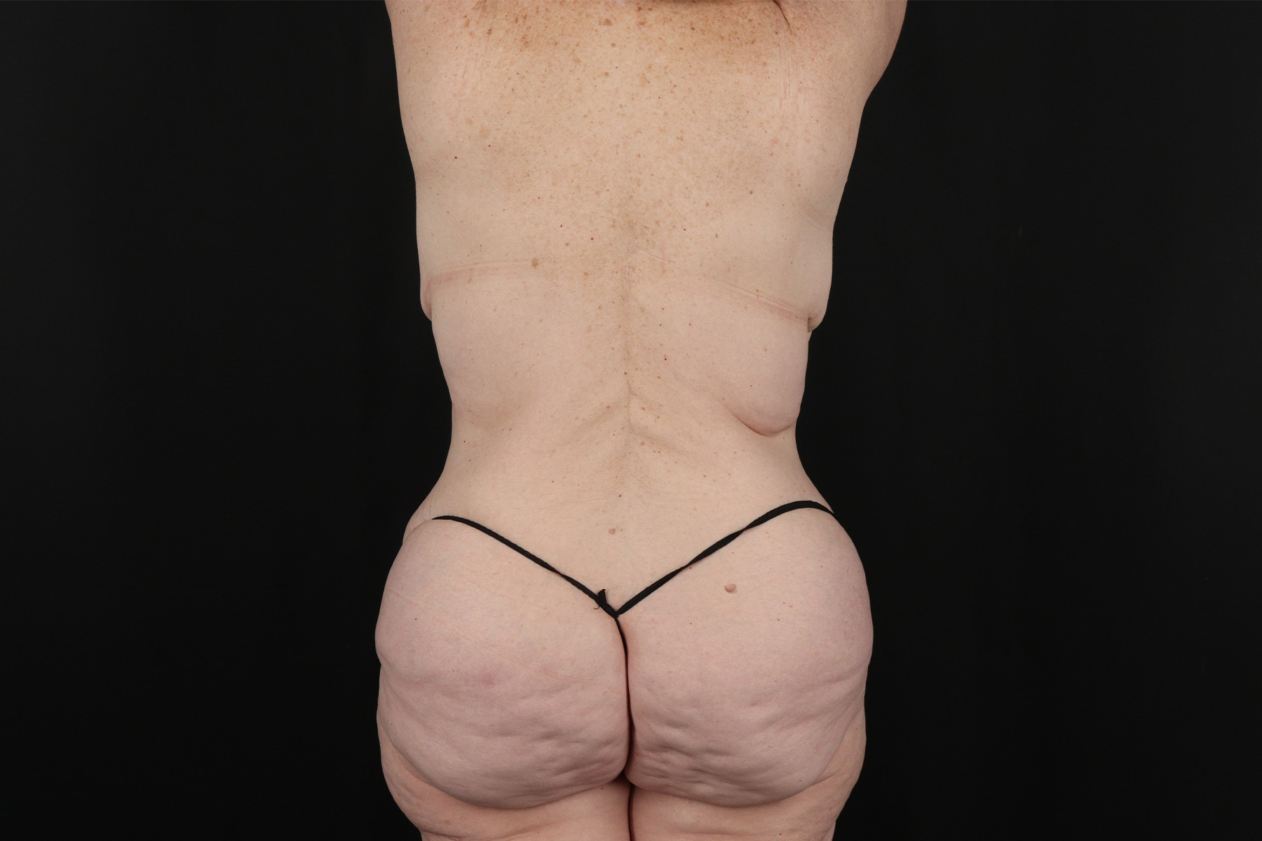 Cosmetic Body Lift Before & After Patient #9757