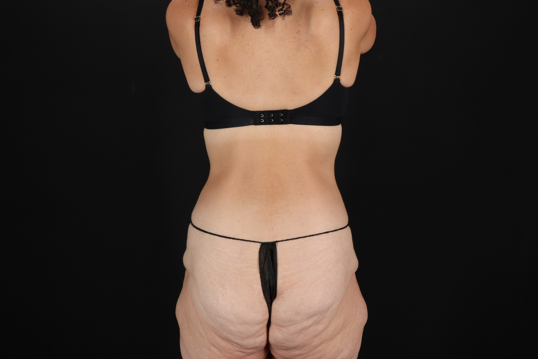 Cosmetic Body Lift Before & After Patient #9760