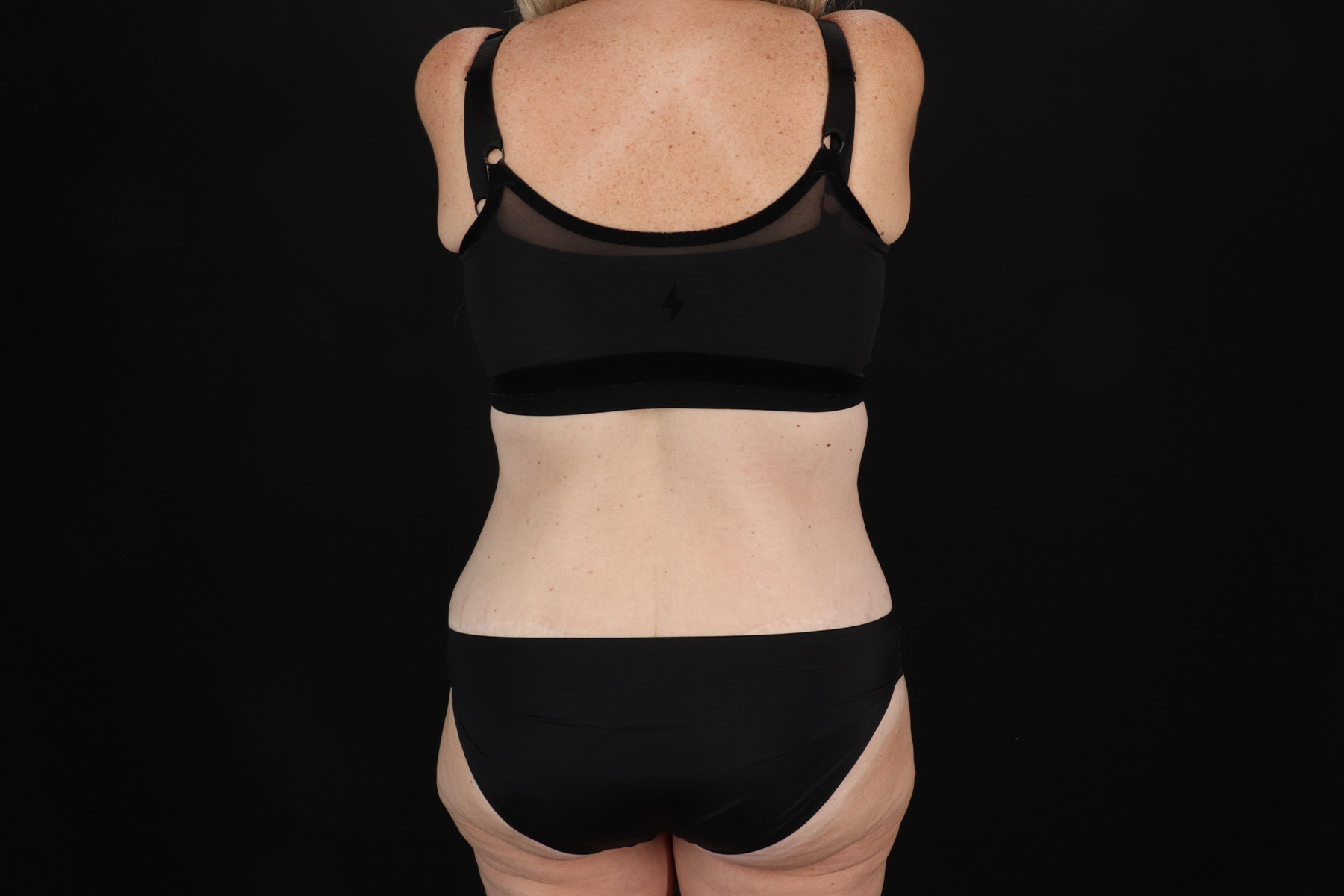 Cosmetic Body Lift Before & After Patient #9767