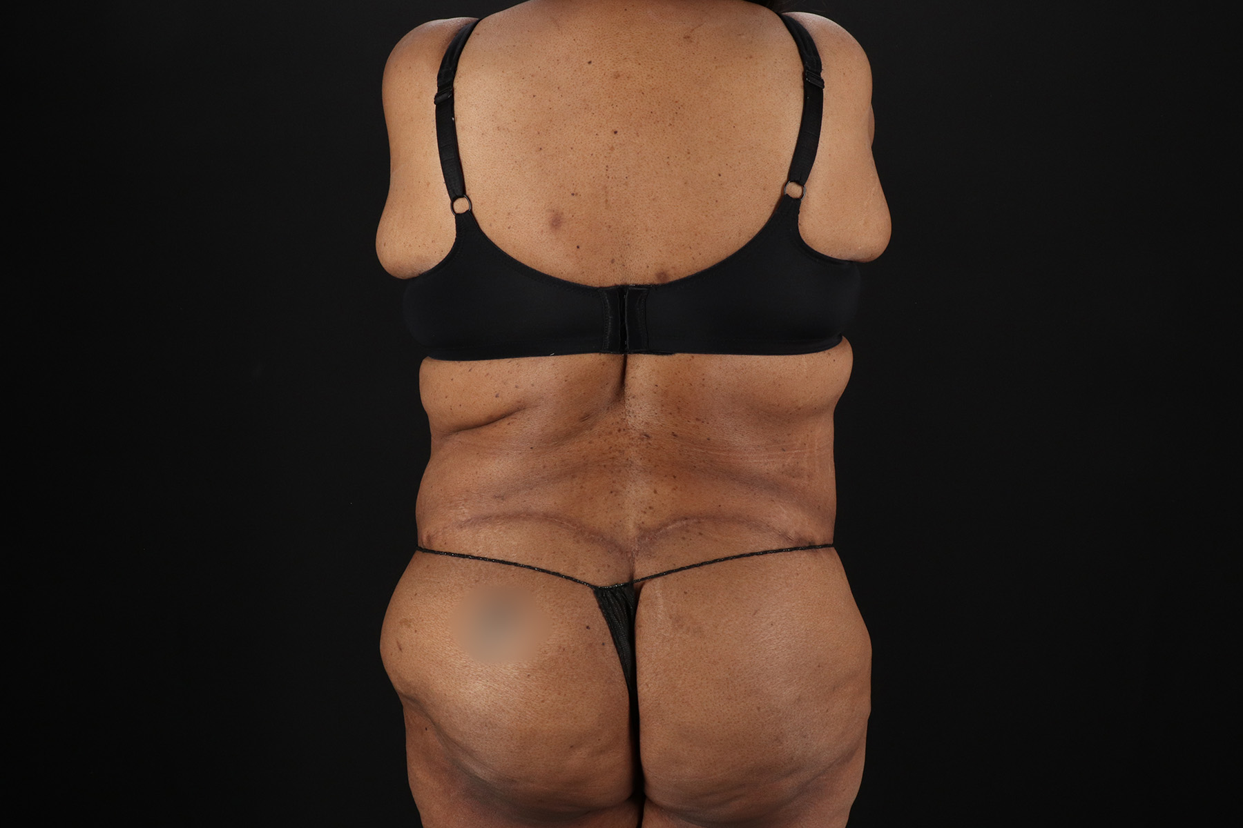 Cosmetic Body Lift Before & After Patient #9761
