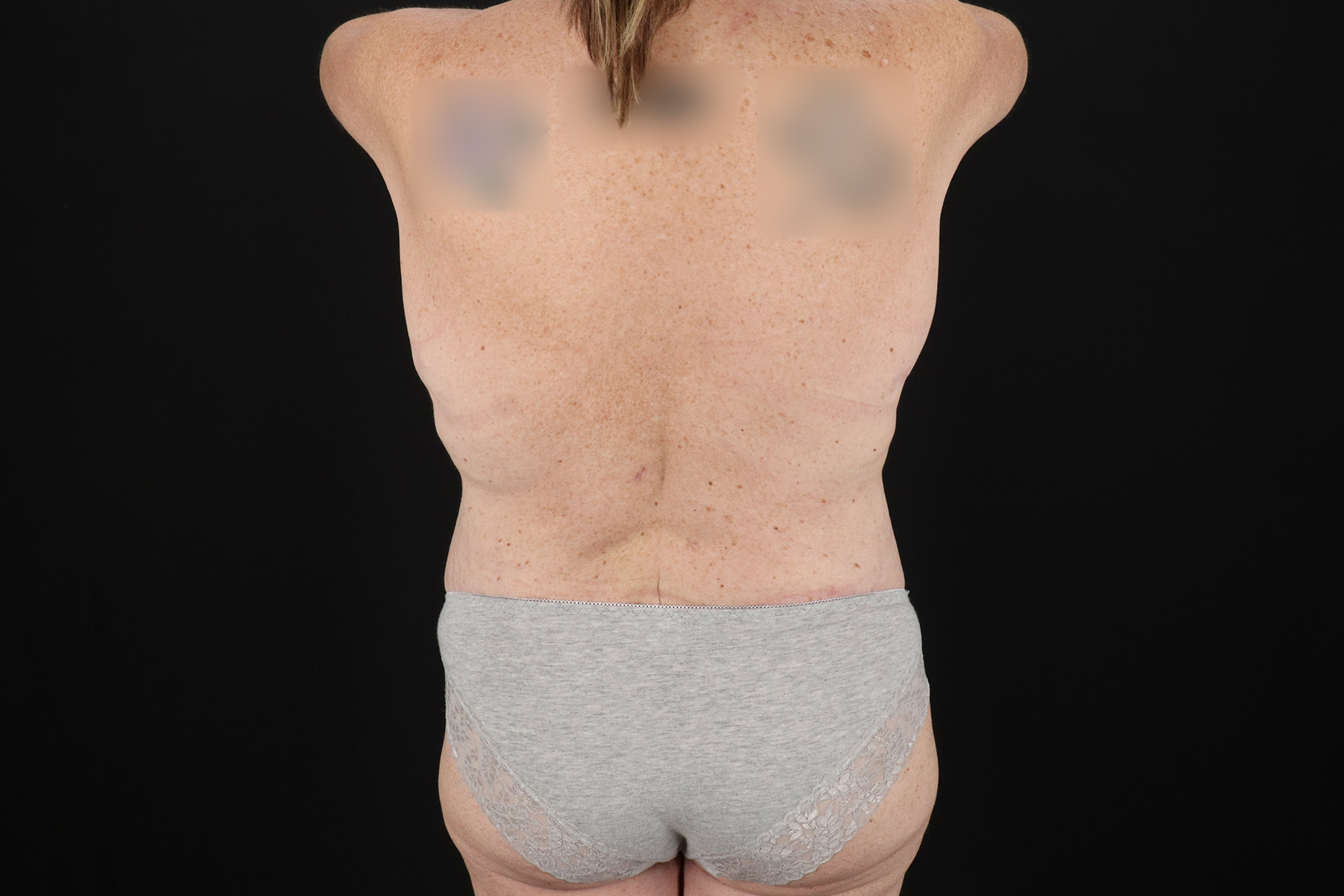 Cosmetic Body Lift Before & After Patient #9763