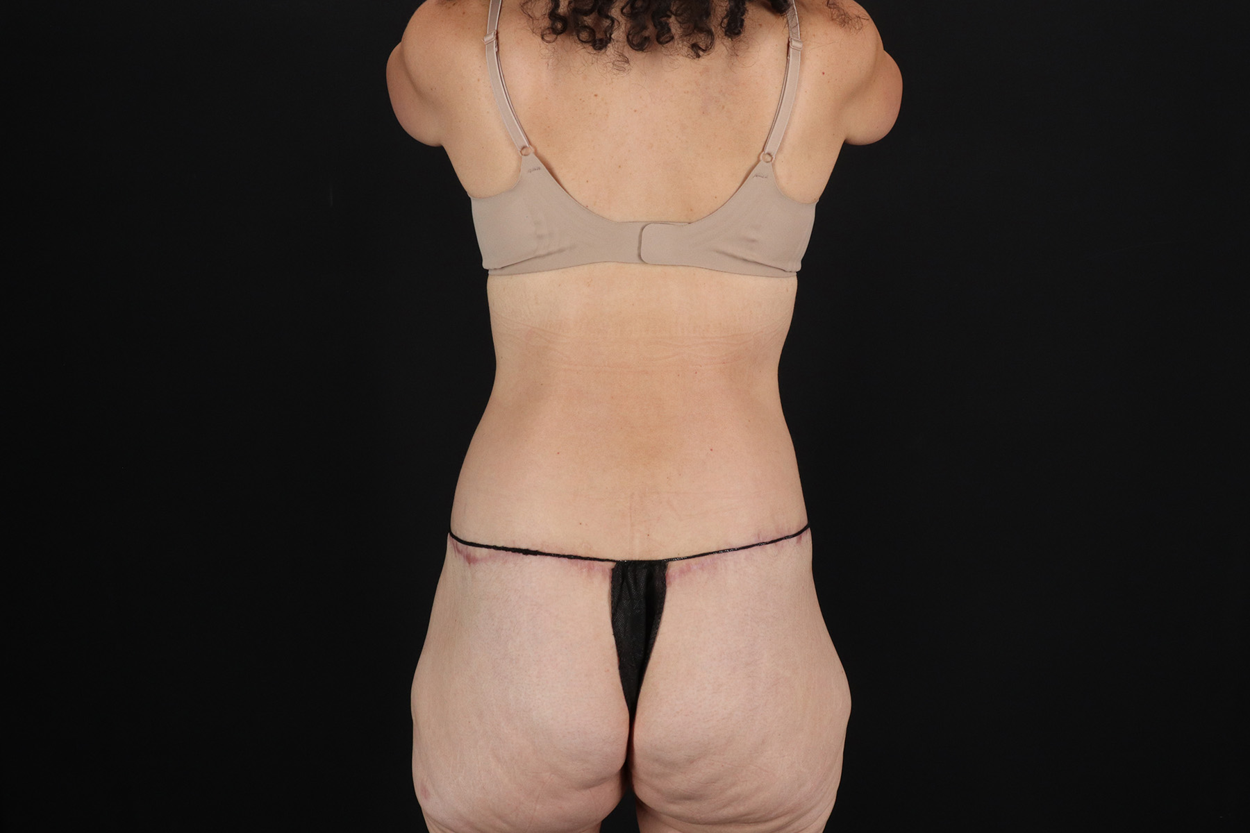 Cosmetic Body Lift Before & After Patient #9760