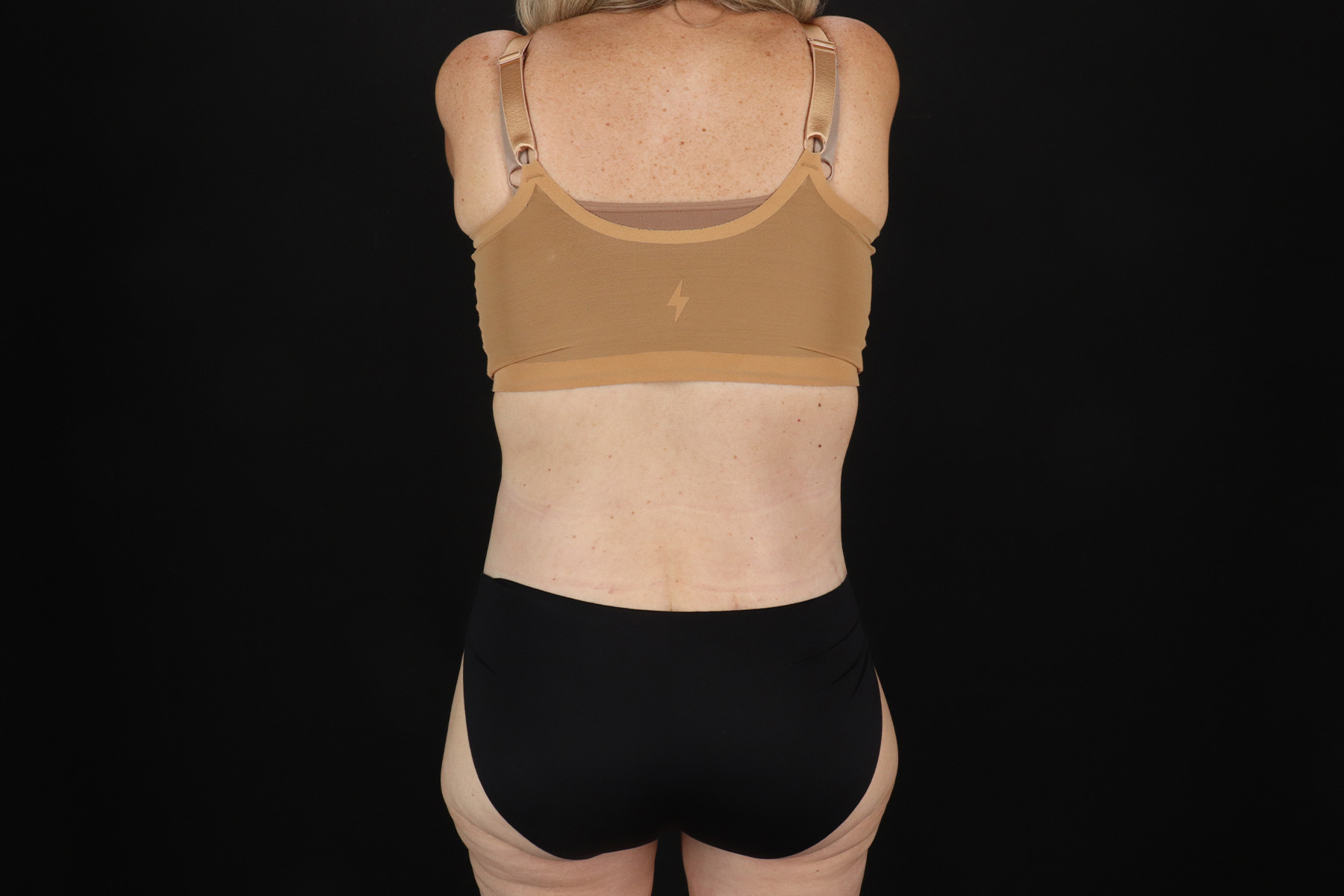 Cosmetic Body Lift Before & After Patient #9767