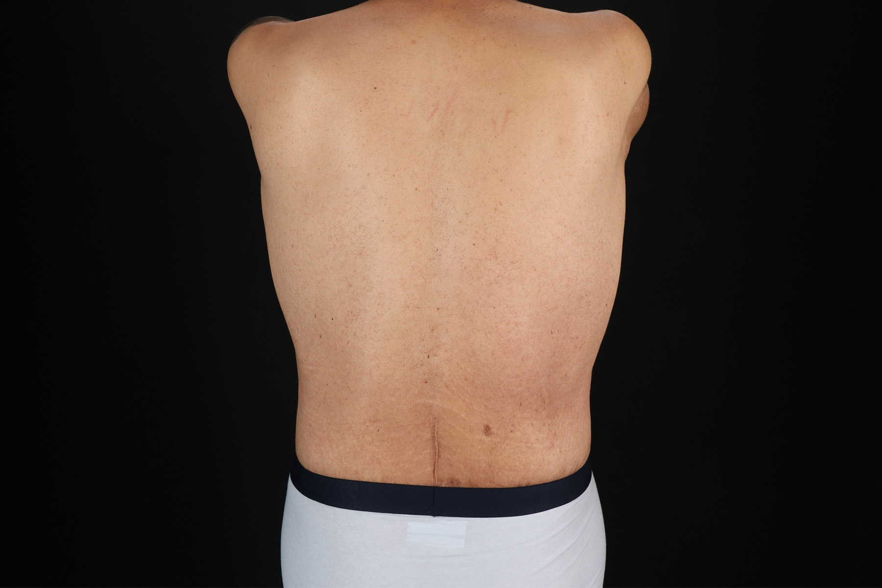 Cosmetic Body Lift Before & After Patient #9764