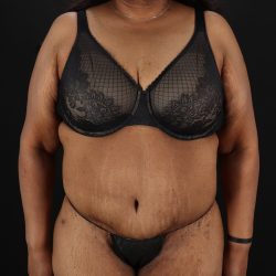 Cosmetic Body Lift Before & After Patient #9761